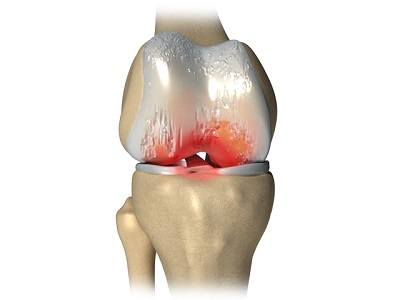 Чехия лечение артроза коленного сустава thumbnail