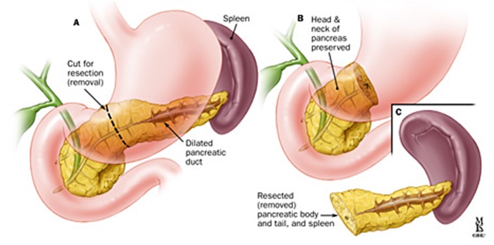Резекция хвоста поджелудочной железы лечение