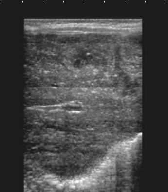 Подкапсульная гематома у новорожденного thumbnail