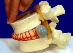 межпозвоночная грыжа