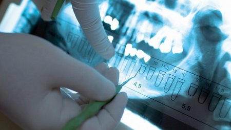 Немедленная дентальная имплантация в Германии