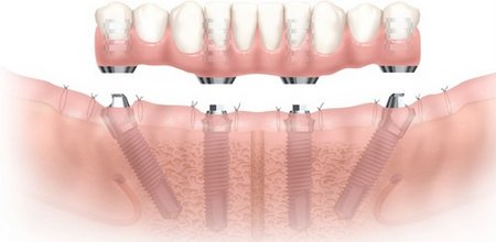 Комбинированная имплантация зубов в Германии