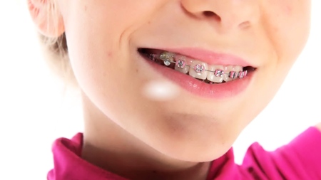 Цветные брекет-системы в Германии