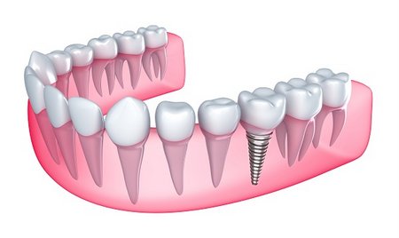 Зубные импланты Endopore в Израиле