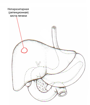 Киста печени лечение у мужчин. Непаразитарные кисты печени кт. Кисты печени клинические рекомендации. Киста и гемангиома в печени.