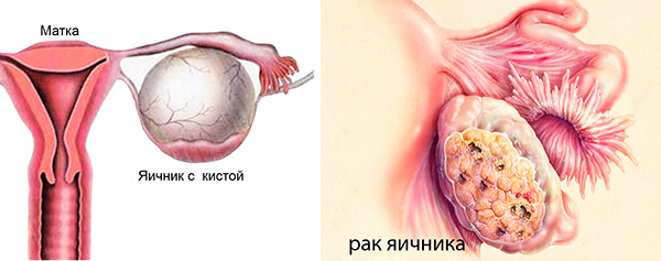 Рак яичников картинки