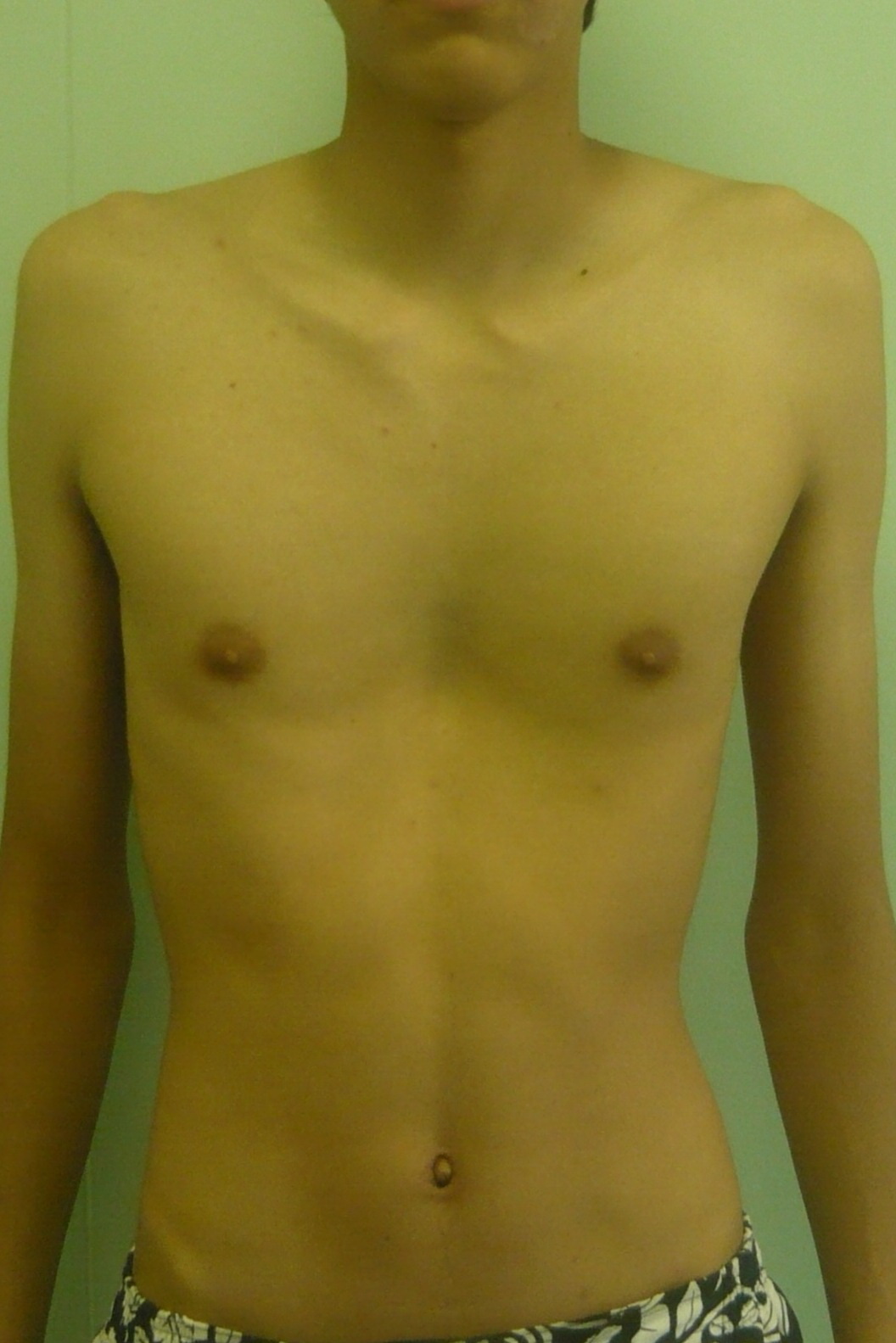 Результаты операции - грудь сапожника Хирургия воронкообразной деформации грудной клетки